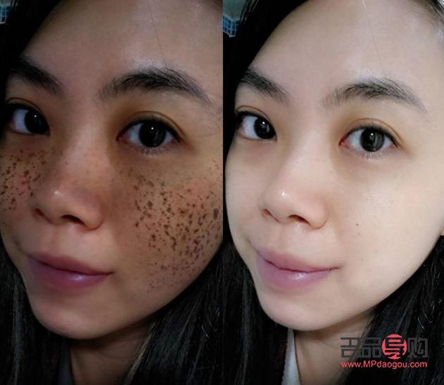 <h3>美容能否有效祛斑？</h3>