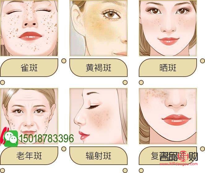 美容能否有效祛斑？