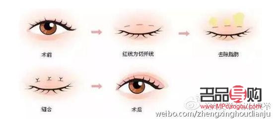 <h3>無痛割雙眼皮：真的無痛嗎？</h3>