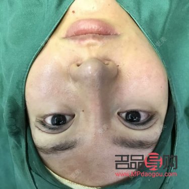 無痛割雙眼皮：真的無痛嗎？