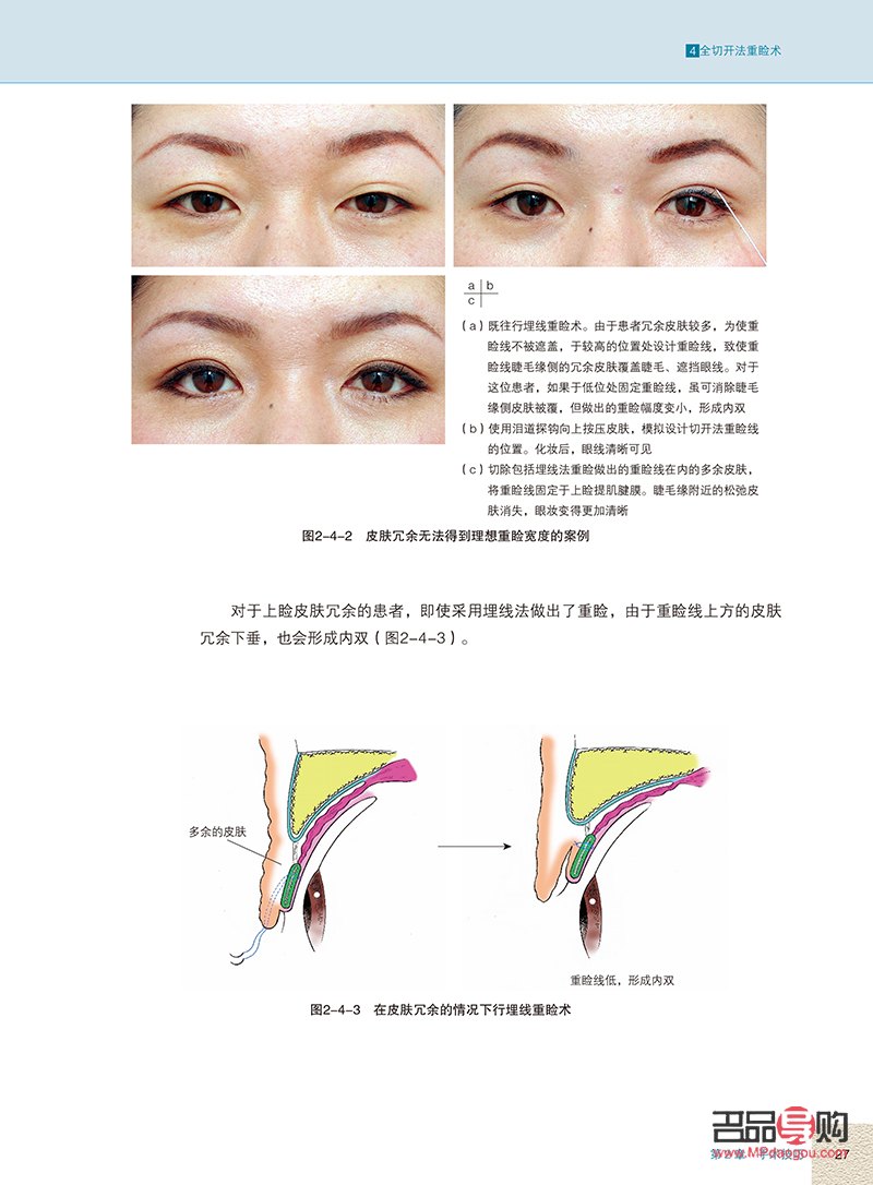 眼整形美容手術(shù)(眼整形美容手術(shù)圖譜)