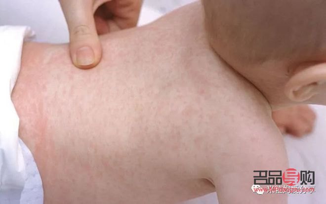出疹過后怎么護理身體(出疹過后怎么護理身體呢)