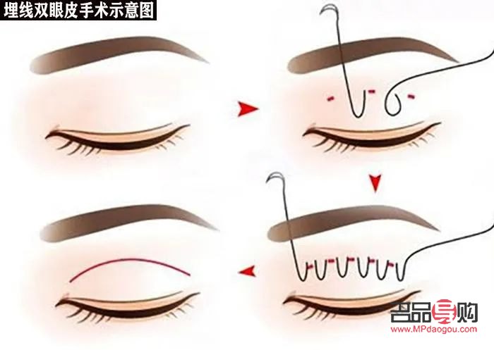 自己弄出雙眼皮小竅門圖片(自己弄出雙眼皮小竅門圖片大全)