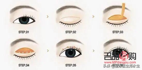 自己弄出雙眼皮小竅門圖片(自己弄出雙眼皮小竅門圖片大全)