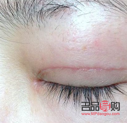 雙眼皮增生初期圖片及詳解