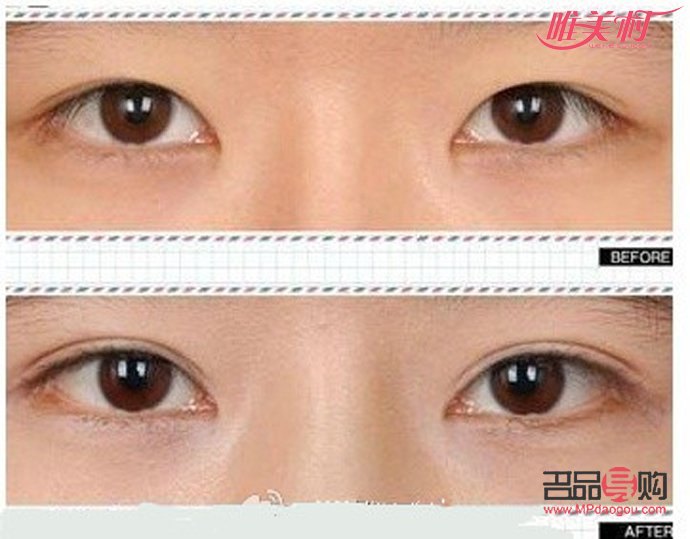 開眼角的圖片前后對比(開眼角圖片前后對比照片效果圖)