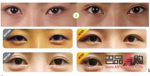 開眼角的圖片前后對比(開眼角圖片前后對比照片效果圖)