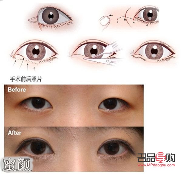 開眼角的圖片前后對比(開眼角圖片前后對比照片效果圖)