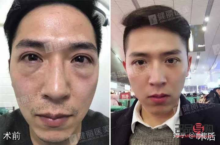 眼袋抽脂手術(shù)視頻(割眼袋視頻過程高清圖片)