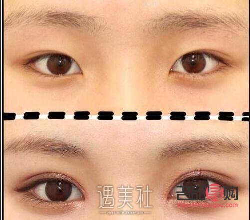 <h3>納米無痕雙眼皮形成過程全解析</h3>