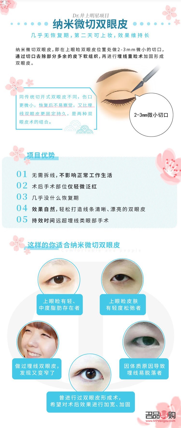 納米無痕雙眼皮形成過程全解析