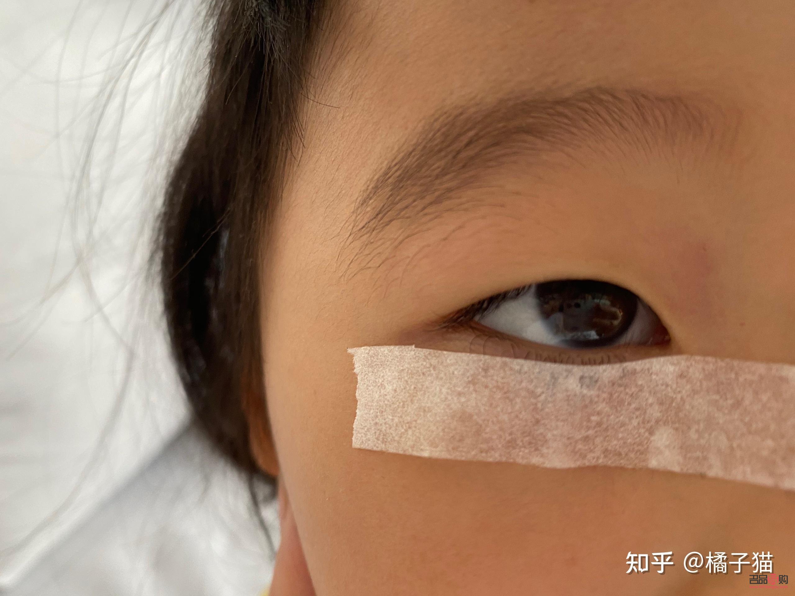 下眼瞼倒睫手術多少錢醫(yī)保報銷(下眼瞼倒睫手術可以報銷嗎)