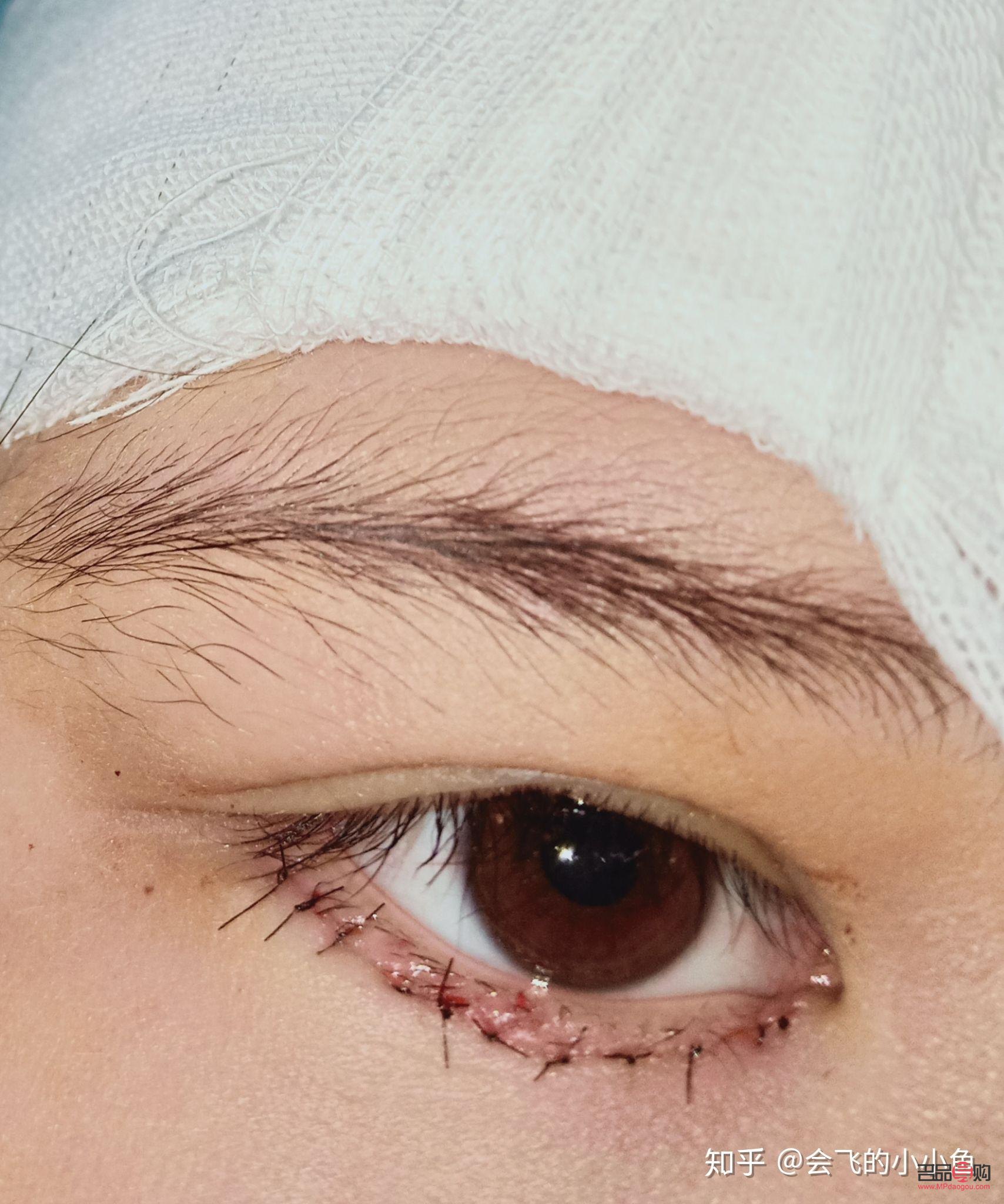 下眼瞼倒睫手術多少錢醫(yī)保報銷(下眼瞼倒睫手術可以報銷嗎)