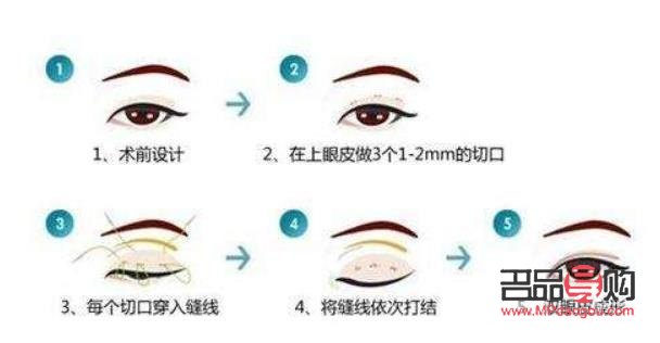 <h3>新加坡雙眼皮埋線價格探究</h3>