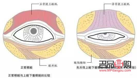 眼皮下垂(眼皮下垂是什么原因)