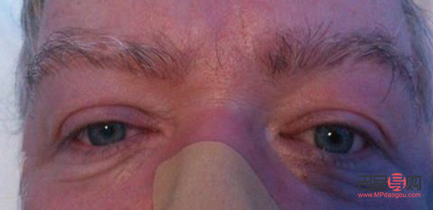 眼皮下垂(眼皮下垂是什么原因)