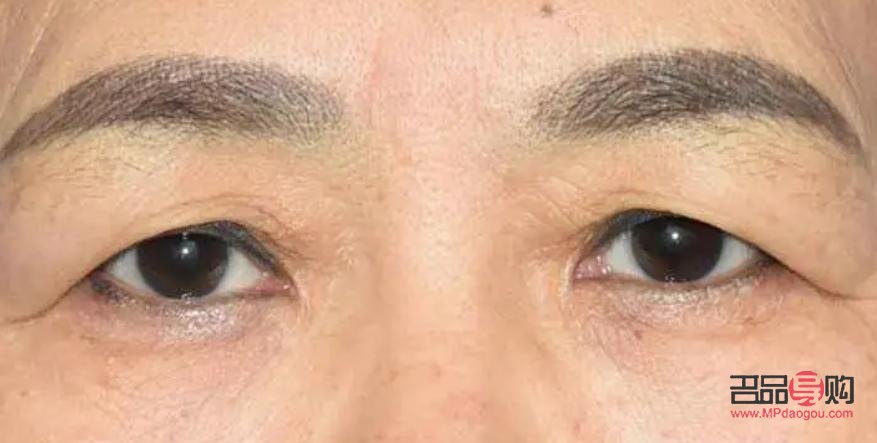 割雙眼皮老了會(huì)下垂嗎(割雙眼皮老了會(huì)下垂嗎圖片)