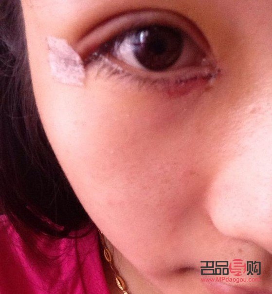 微創(chuàng)雙眼皮多久可以恢復(fù)自然眼皮(微創(chuàng)雙眼皮多久可以恢復(fù)自然眼皮了)