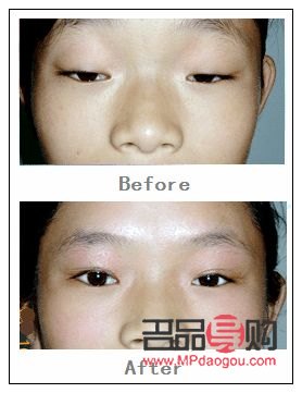 <h3>眼皮下垂最佳非手術(shù)解決方案</h3>