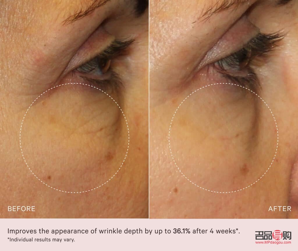 <h3>眼皮下垂最佳非手術(shù)解決方案</h3>