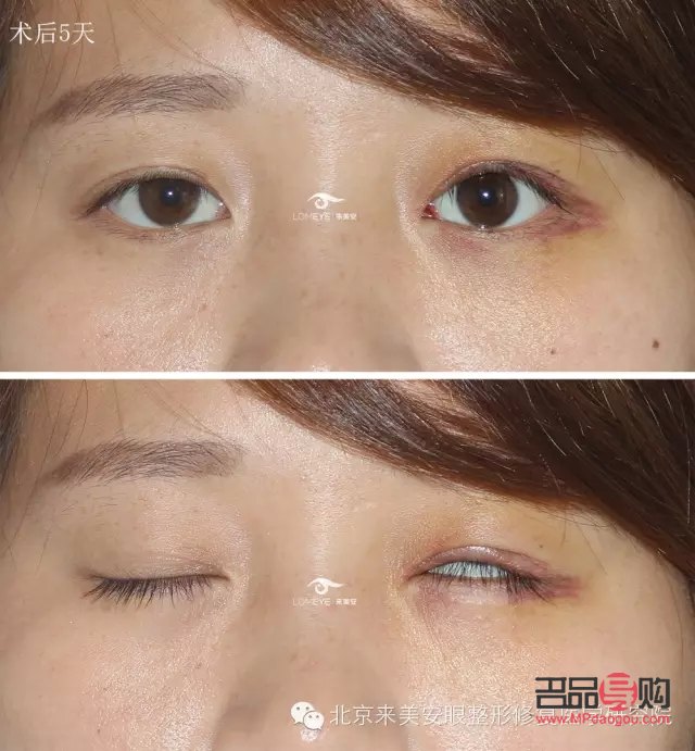<h3>眼皮下垂最佳非手術(shù)解決方案</h3>