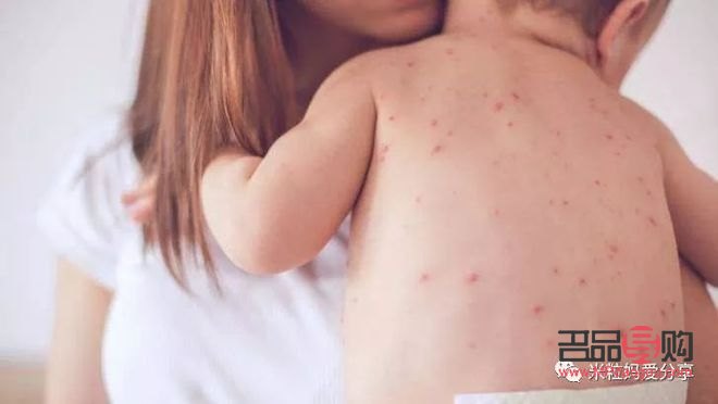 退疹后怎么護理身體呢(退疹后怎么護理身體呢圖片)
