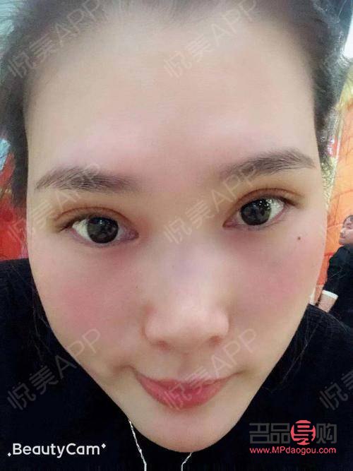 割雙眼皮多久可以出去玩(割雙眼皮多長時(shí)間可以出門)