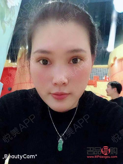 割雙眼皮多久可以出去玩(割雙眼皮多長時(shí)間可以出門)