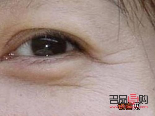 眼部皺紋消除最好方法視頻(眼部皺紋消除最好方法視頻講解)