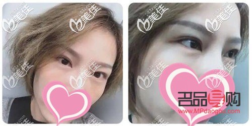 無痕去眼袋一般多少錢(40歲割眼袋能維持多久)