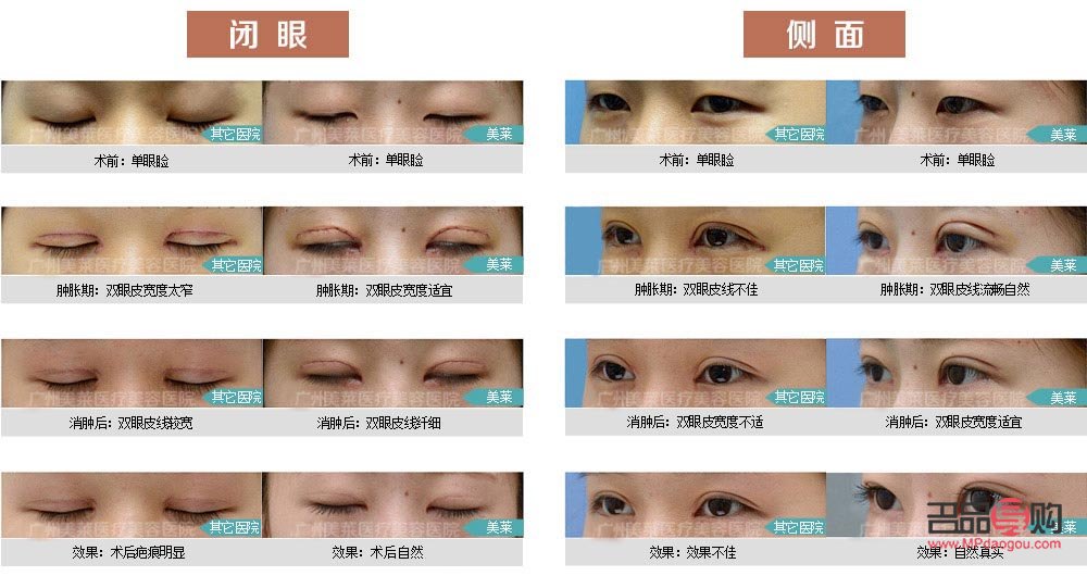 翹睫雙眼皮和全切有什么區(qū)別圖片(翹睫雙眼皮和全切有什么區(qū)別圖片對比)