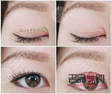 翹睫雙眼皮和全切有什么區(qū)別圖片(翹睫雙眼皮和全切有什么區(qū)別圖片對比)