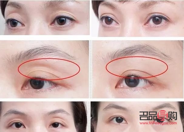 眼眶凹陷怎么恢復(fù)飽滿 中醫(yī)調(diào)理(眼眶凹陷怎么恢復(fù)飽滿 中醫(yī)調(diào)理方法)