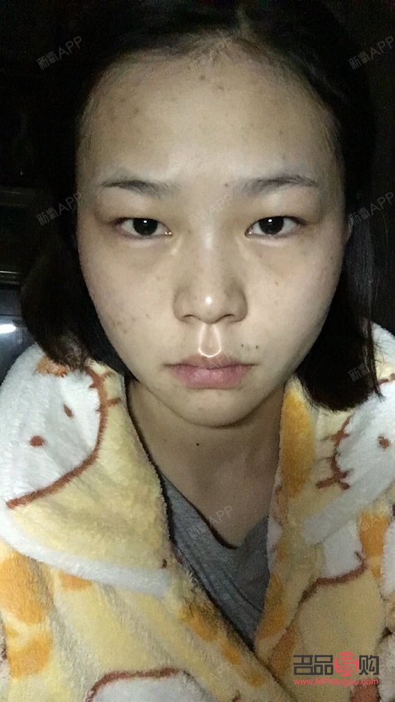 <h3>天生腫眼泡怎么消除？不手術(shù)也能做到！</h3>