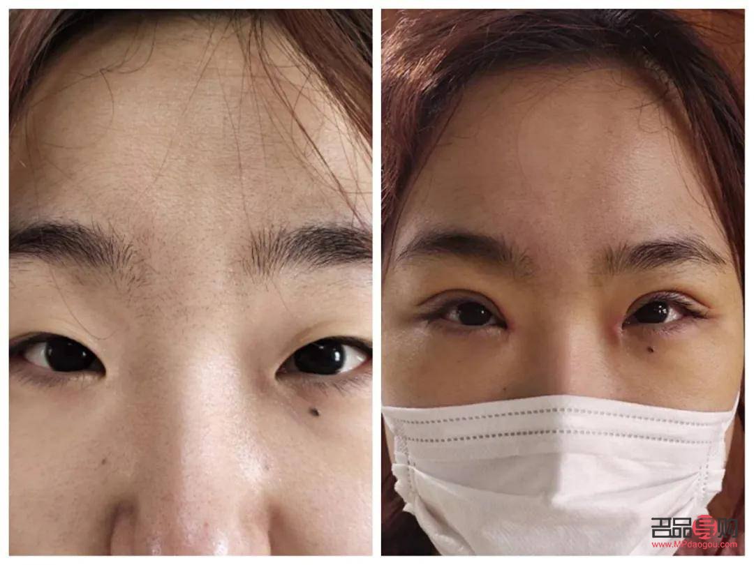 天生腫眼泡怎么消除？不手術(shù)也能做到！