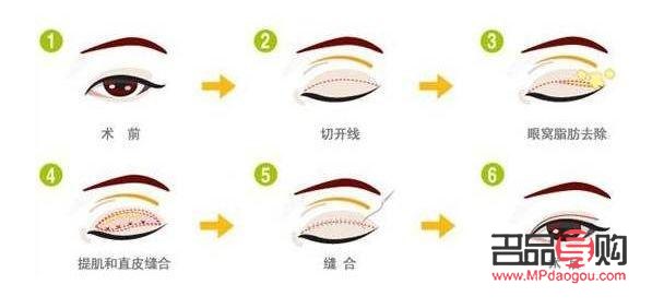 <h3>雙眼皮手術(shù)恢復(fù)自然需要多久？</h3>