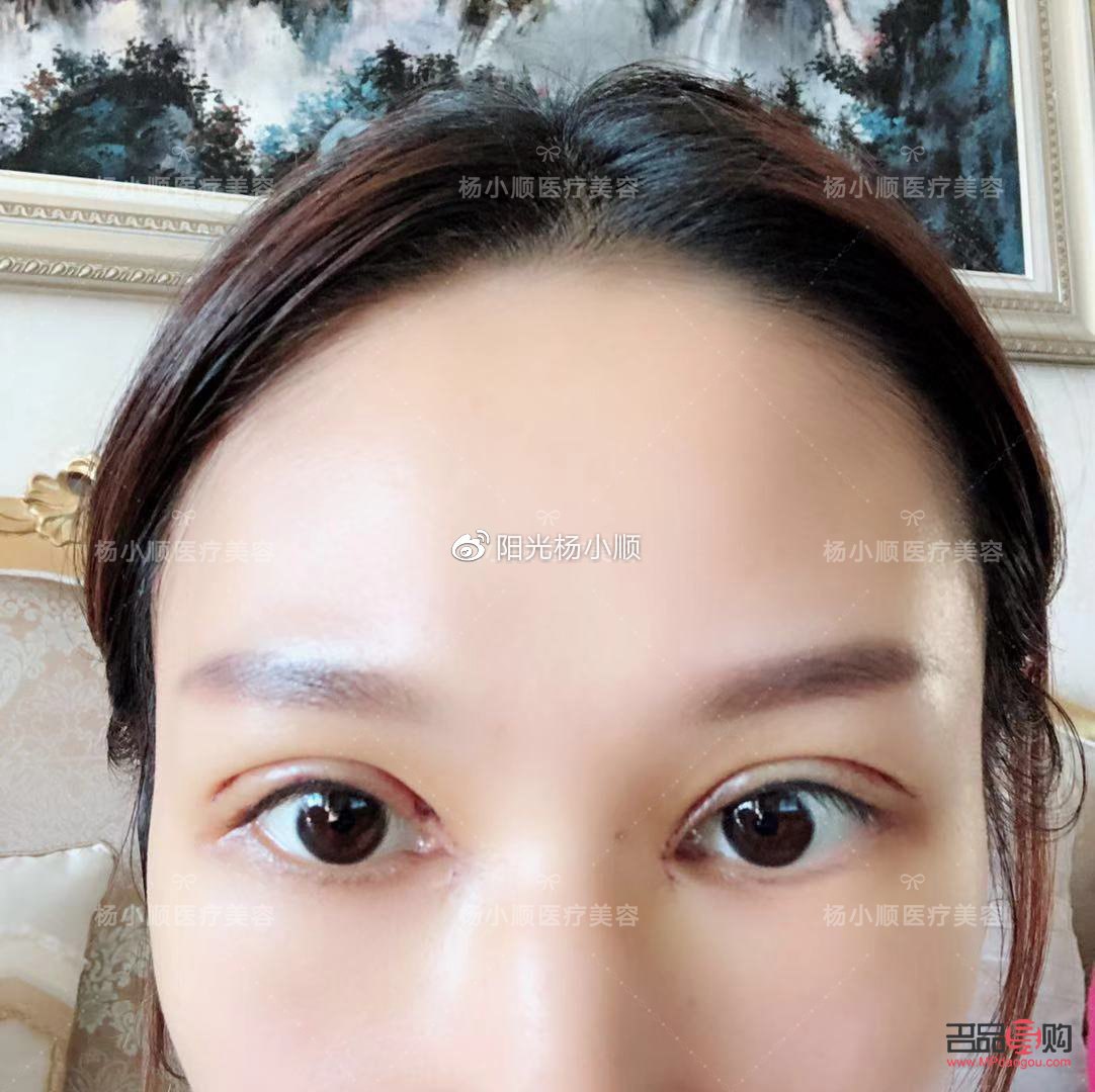 <h3>雙眼皮手術(shù)恢復(fù)自然需要多久？</h3>