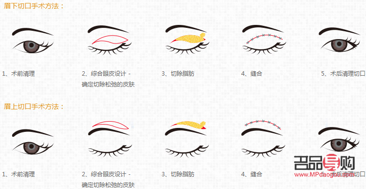 <h3>探究上眼皮松弛的成因及影響</h3>