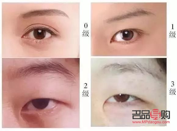 內(nèi)眼角開太大會有什么影響(內(nèi)眼角開太大會有什么影響嘛)