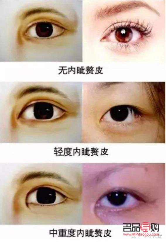 內(nèi)眼角開太大會有什么影響(內(nèi)眼角開太大會有什么影響嘛)