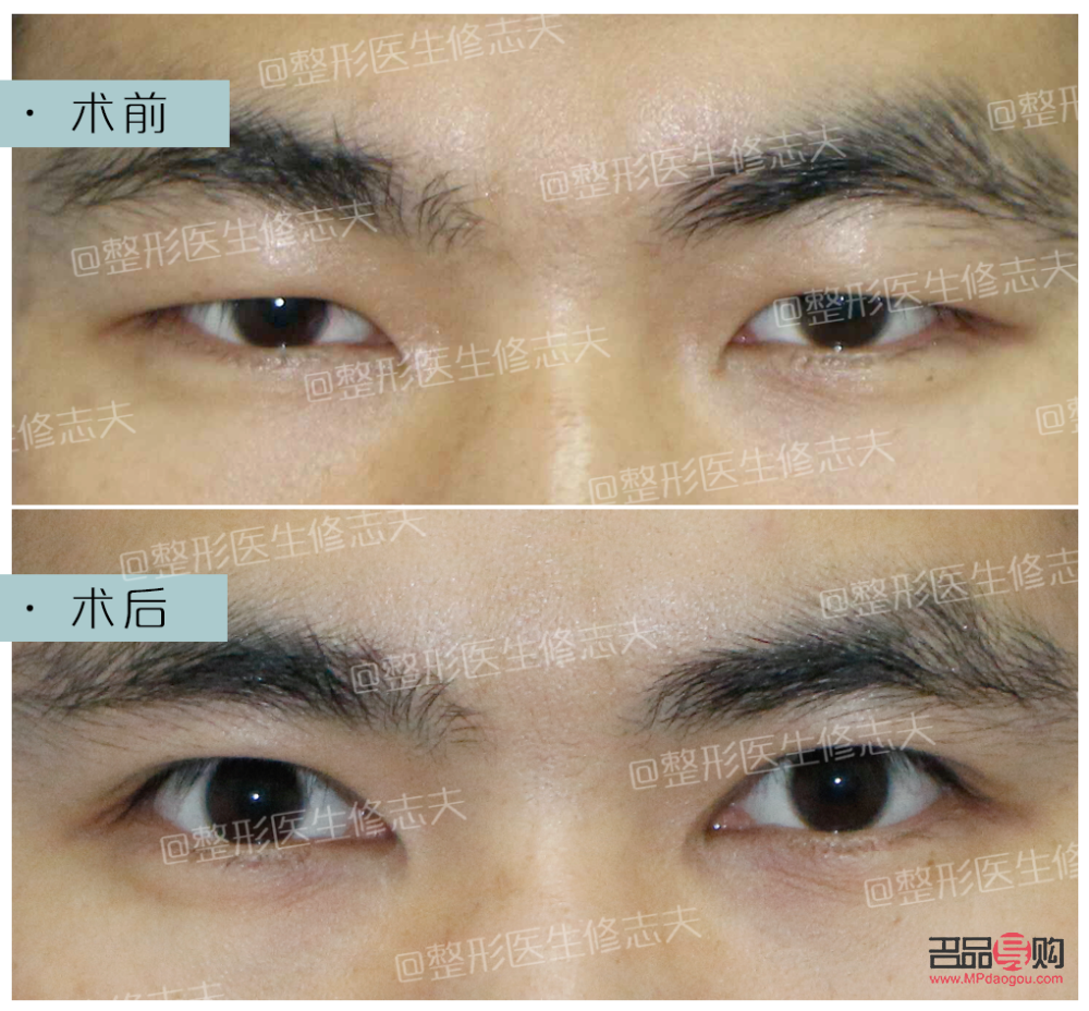 內(nèi)眼角開太大會有什么影響(內(nèi)眼角開太大會有什么影響嘛)