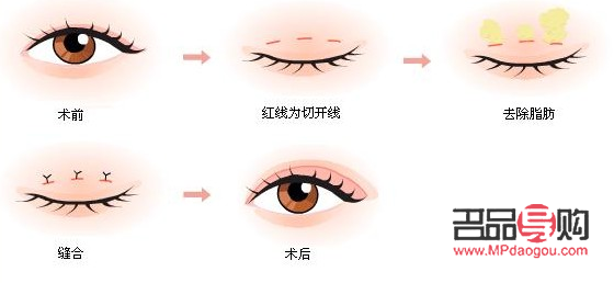 肉眼泡做雙眼皮手術是否需要抽脂？