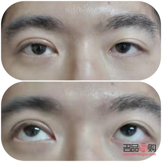 眼皮肌無力做雙眼皮可以改善嗎(眼皮肌無力做雙眼皮可以改善嗎圖片)