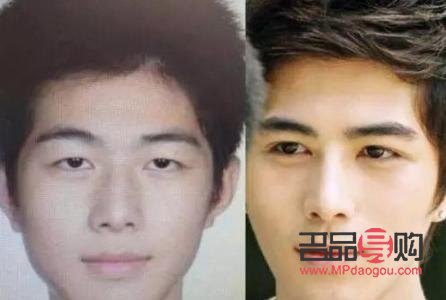 眼皮肌無力做雙眼皮可以改善嗎(眼皮肌無力做雙眼皮可以改善嗎圖片)