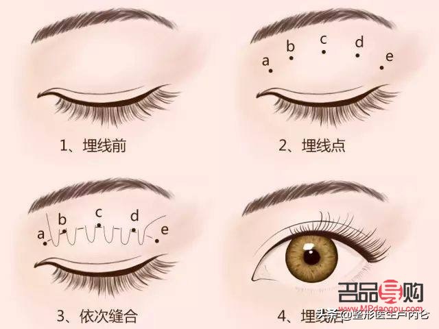 雙眼皮所有類型(雙眼皮所有類型圖)
