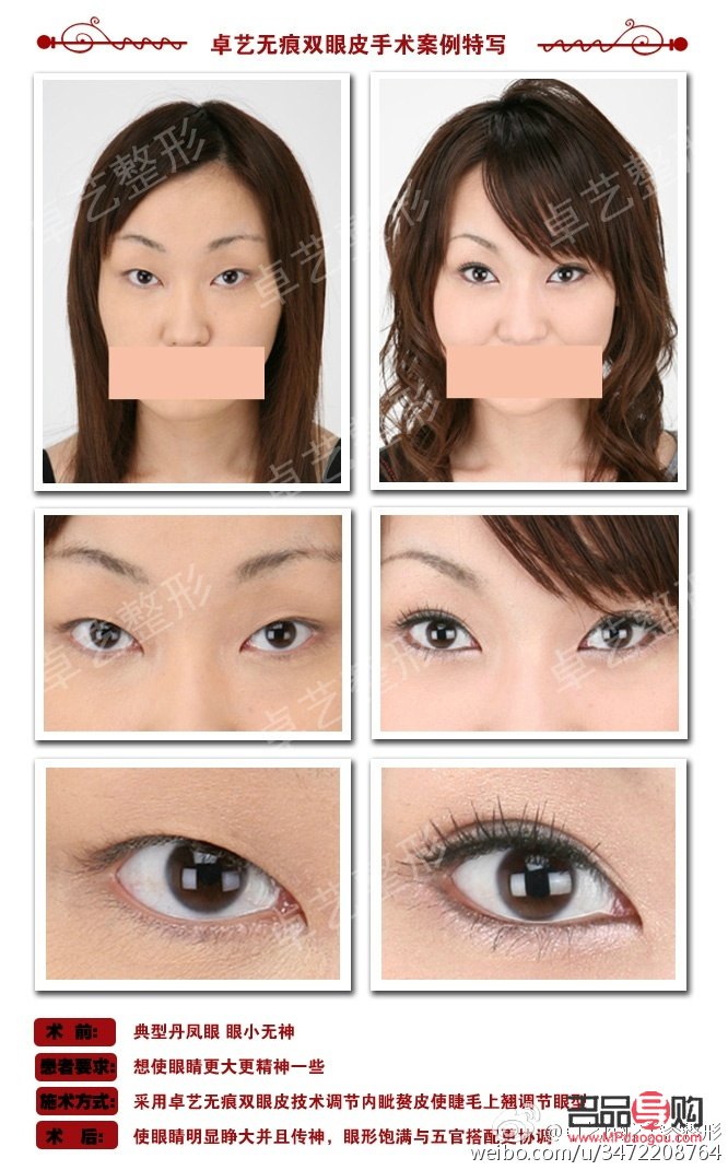 雙眼皮所有類型(雙眼皮所有類型圖)