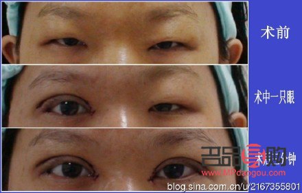 翹睫雙眼皮恢復(fù)全過(guò)程圖解