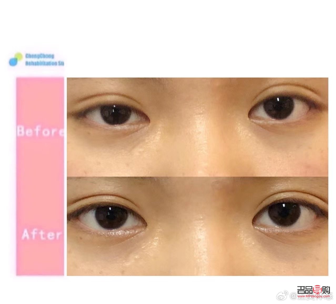 眼睛一大一小矯正費(fèi)用區(qū)別詳解