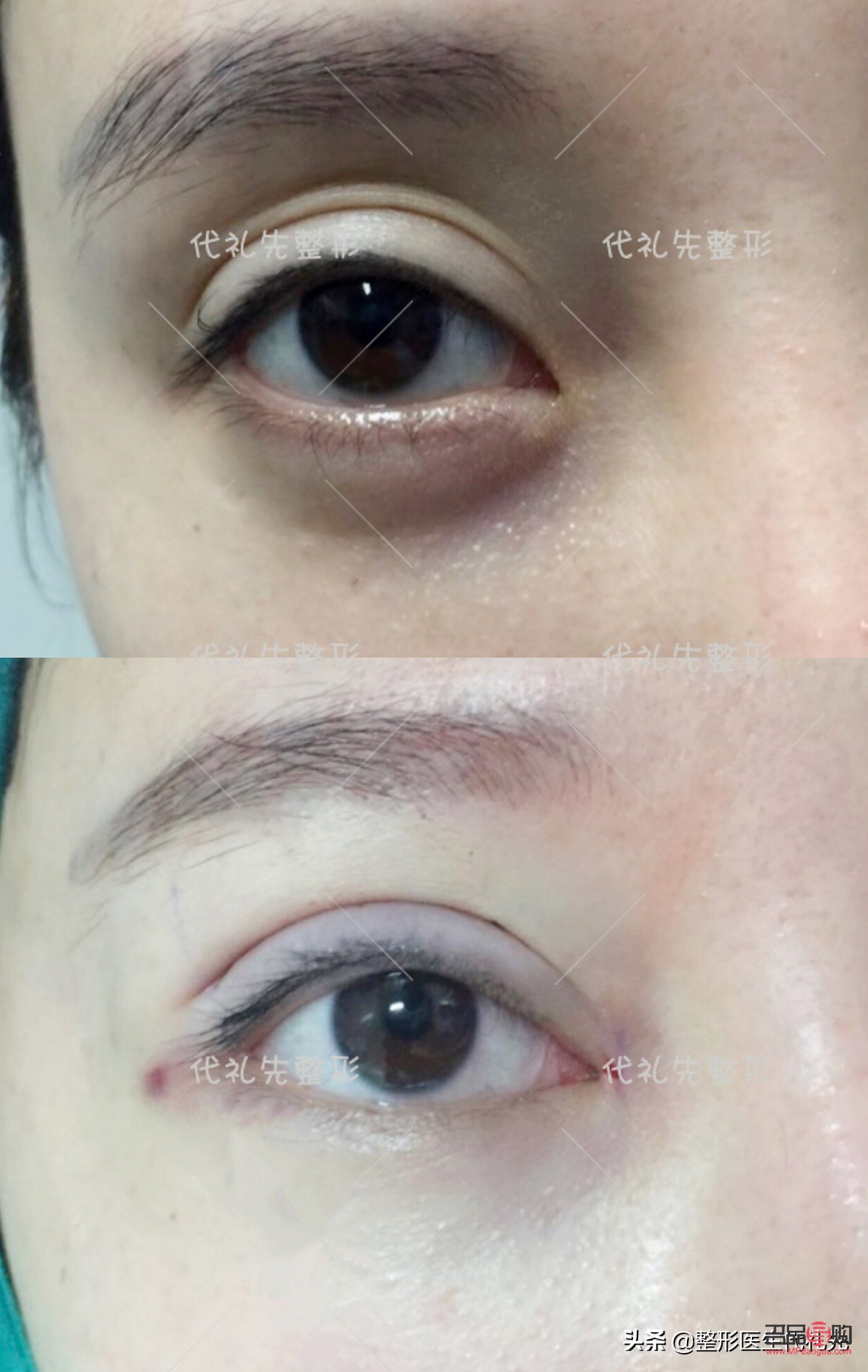 眼窩填充術(shù)大概要多少錢(眼窩脂肪填充第3天照片)