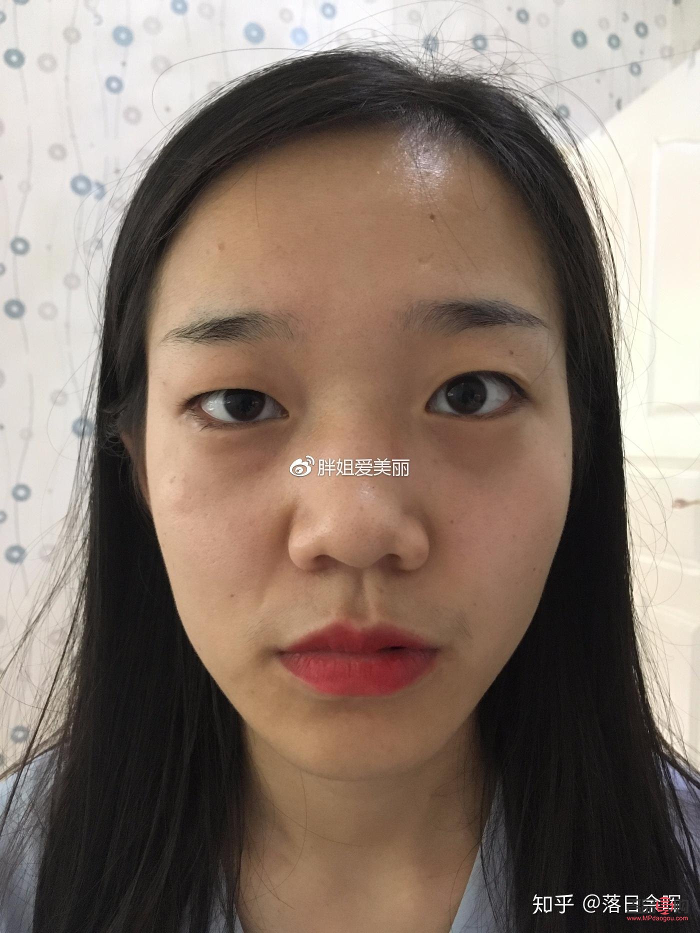 高低眼怎么矯正(高低眼怎么矯正多少錢)